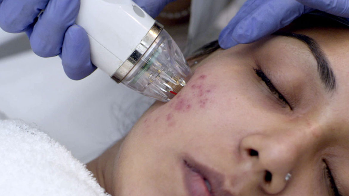Acne-Scar-Treartment