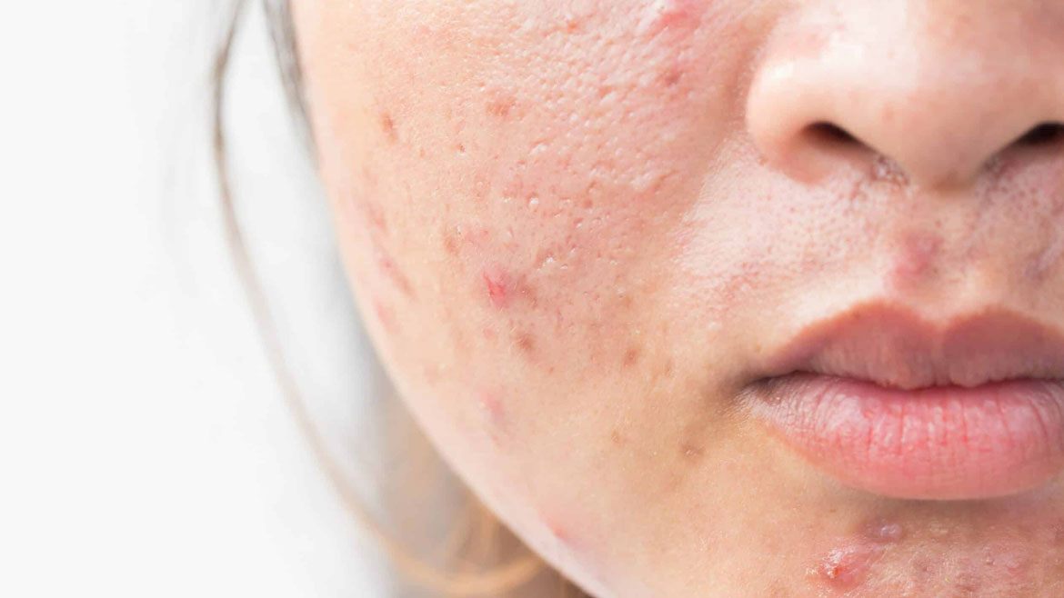 Acne-Scar-Treatment
