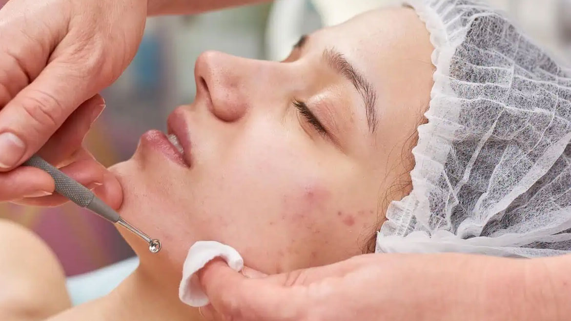 Acne Treatment