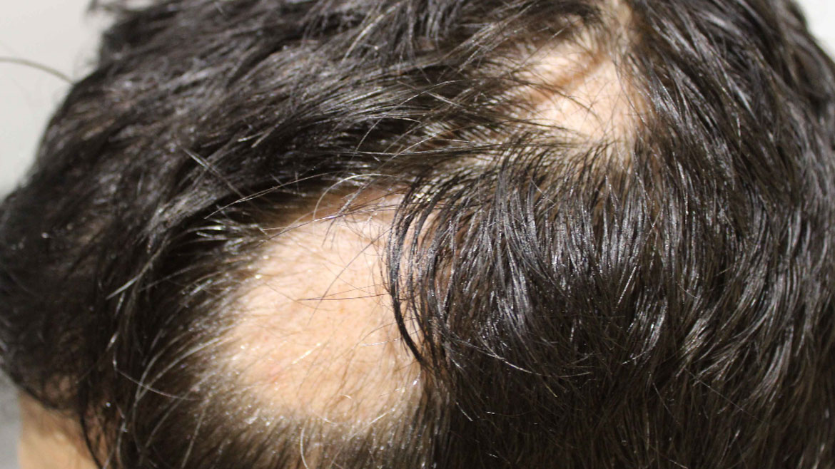 Alopecia