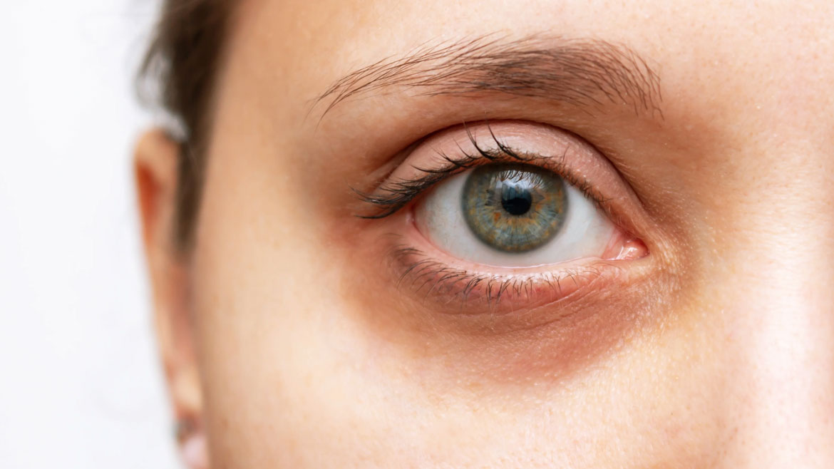 Dark-Circles