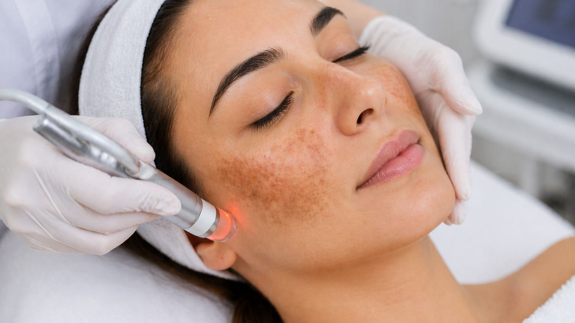 Melasma