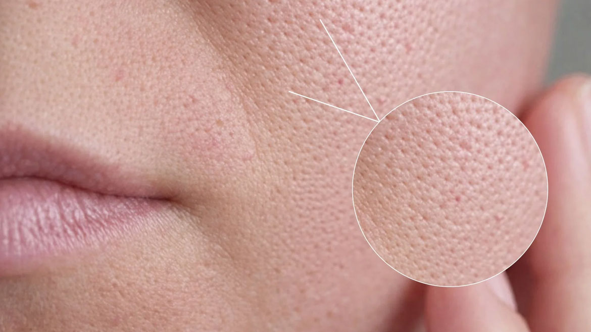 Open-Pores