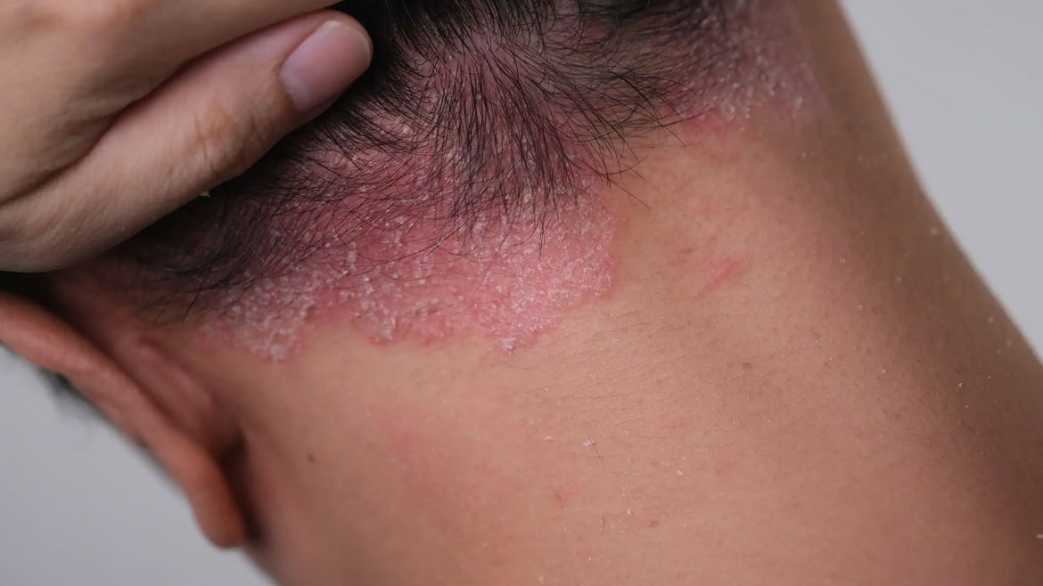 Psoriasis