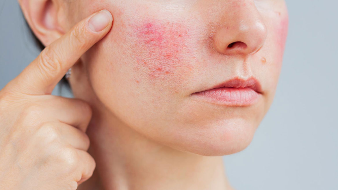 Rosacea