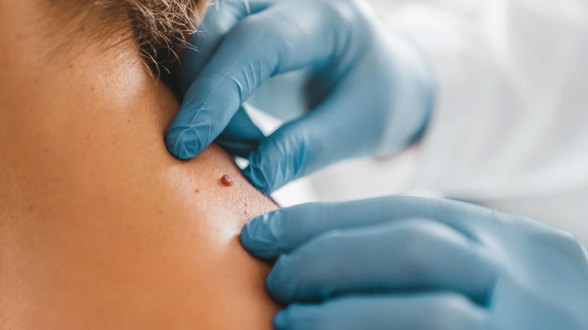 Skin-Tags-&-DPN-Removal
