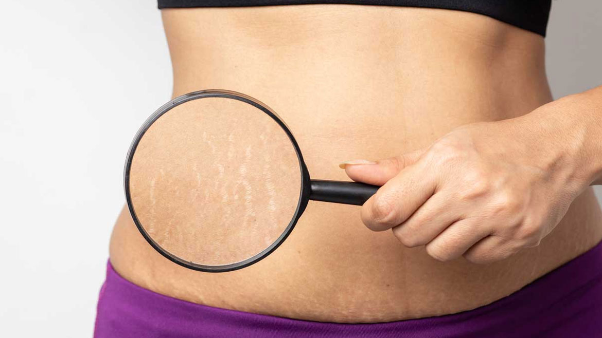 Stretch-Mark-Reduction